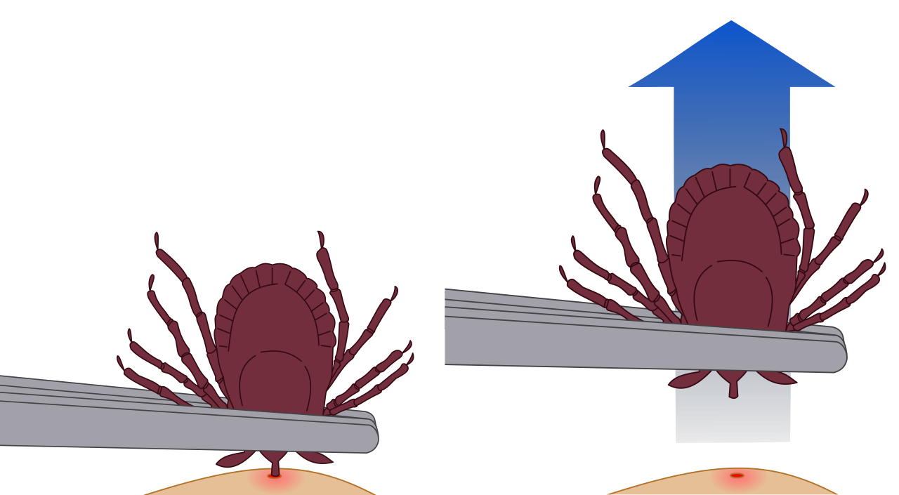 Illustration: tweezers grasp the tick from underneath, at skin level, then pull straight up slowly